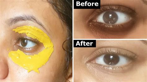 Applying Turmeric Around The Eyes In Minutes And See What Will