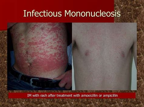 Mononucleosis Rash Mononucleosis Signs Symptoms And Complications
