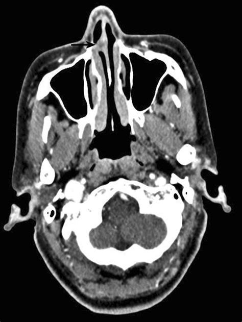 Figure 1 From Sinonasalnasopharyngeal Pleomorphic Adenoma And