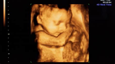 Our trained 3d 4d 5d ultrasound Will protecting the unborn be the next civil rights issue ...