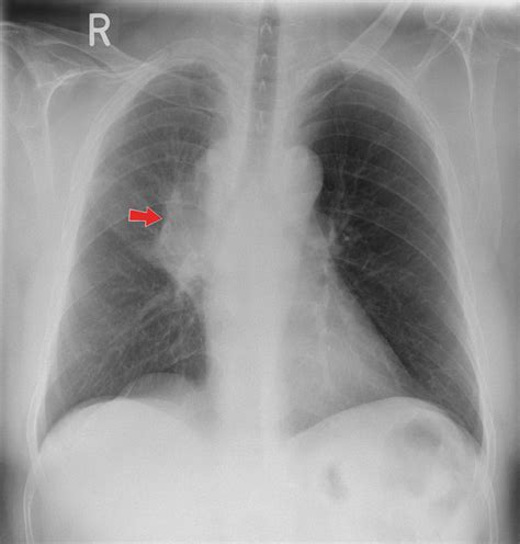 Chest X Ray Showing Right Hilar Mass With Perihilar Opacity Red Arrow