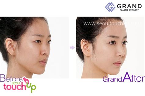 Korean Nose Lift Bridge And Tip Before After Seoul Touchup