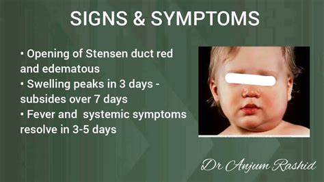 Mumps Symptoms Treatment Parotid Swelling Parotitis Pediatrics