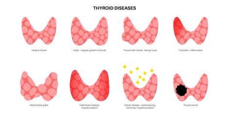 Swollen Thyroid Stock Photos Pictures And Royalty Free Images Istock