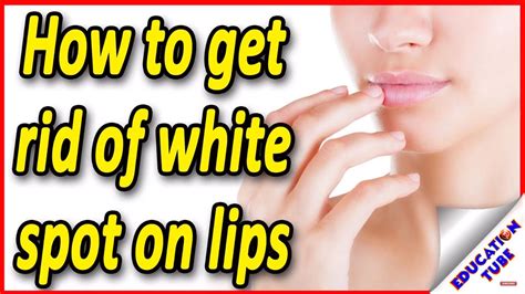 सफ़ेद दाग के घरेलू उपचार Home Remedies For White Spot On Lips Youtube