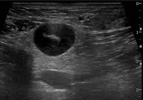 A 75 Year Old Woman With Primary Breast Lymphoma Ultrasound Image Of