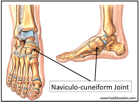 Naviculocuneiform Joint Fusion Footeducation