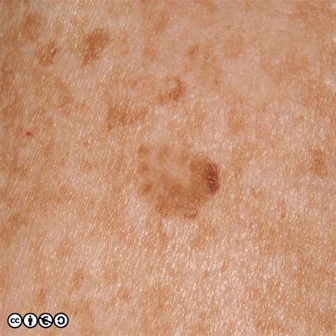 What Does The Early Stage Of Melanoma Look Like Skin Cancer Photos