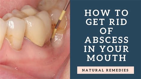 Tooth Abscess Home Remedy Salt Water Bruin Blog