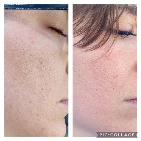 Acne So Im 1 Month Out From My First Rf Microneedling Treatment Can
