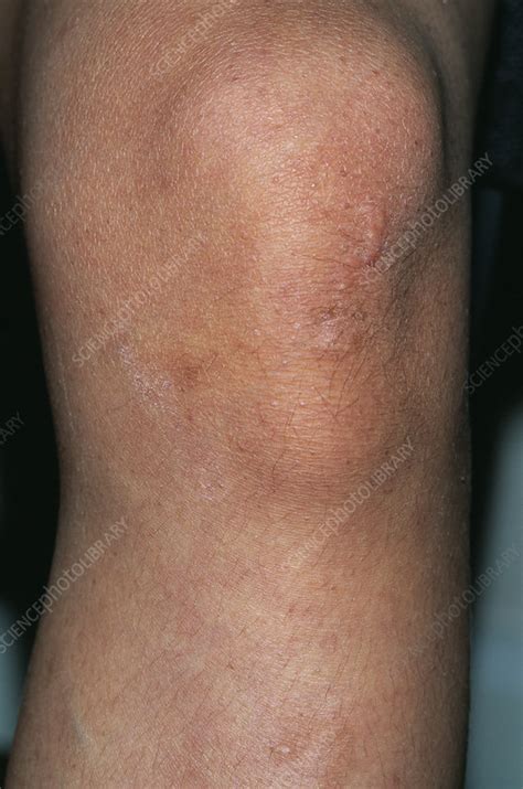 Osgood Schlatters Disease Stock Image M2300300 Science Photo