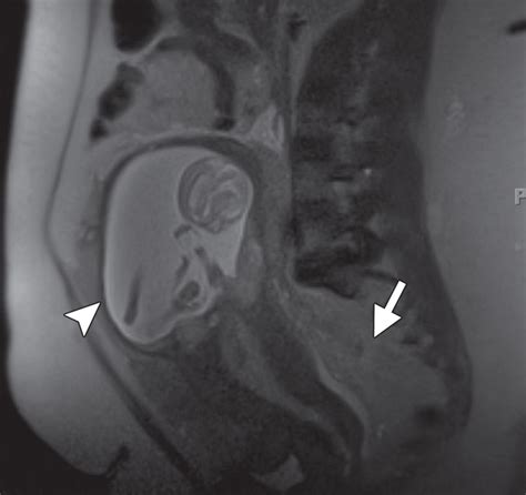 Mr Imaging Findings Of Ectopic Pregnancy A Pictorial Review Radiographics