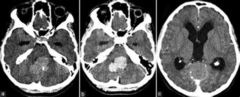Axial Ct Scan Showing Hyperdense Fourth Ventricle Mass Lesion With