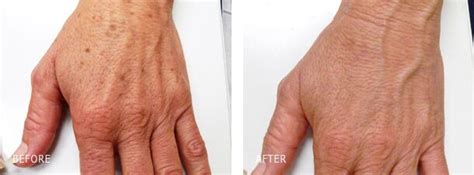 Hand Vein Removal Los Angeles Arm And Hand Vein Sclerotherapy