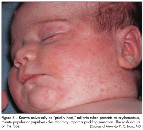 Infant Contact Dermatitis Eczema Free Skin