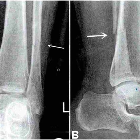 Distribution Of Ankle Fractures In Danis Weber Classification And Of Download Scientific