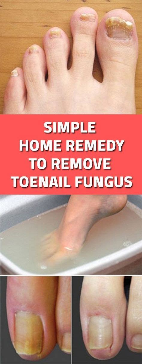Simple Home Remedy To Remove Toenail Fungus Toenail Fungus Home