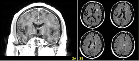 Mri Brain With And Without Iv Contrast Shows Leptomeningeal Disease In