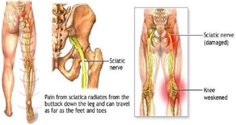 What Are The Natural Treatments For Sciatic Pain Human