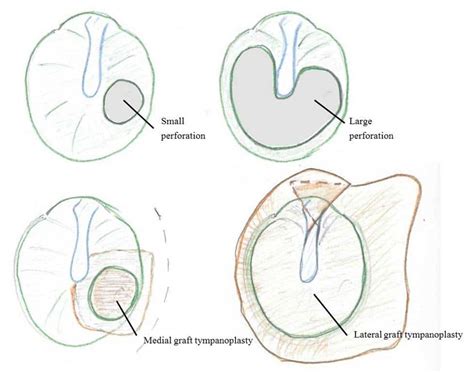 Surgery Of The Eardrum Middle Ear And Mastoid Glacier Ear Nose