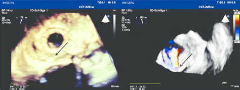 Preoperative 3d Transoesophageal Echocardiography Imaging Of The