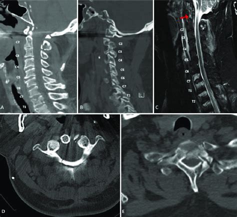 A Midsagittal Ct Showing C2 Posterior Arch Disruption And Comminuted