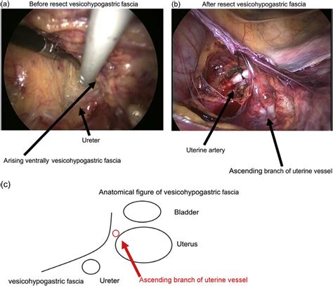 (a) Opening of the paravesical space and detection of the ureter under... | Download Scientific ...