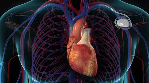 Heart Pacemaker Purpose Procedure And Risks