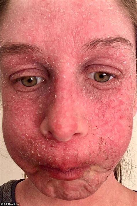 Bride 24 With Severe Eczema Woke Up A Week Before Her Wedding With