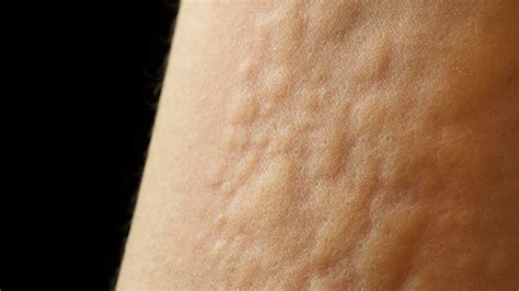 Often, the cause of chronic hives is not clear. Hives