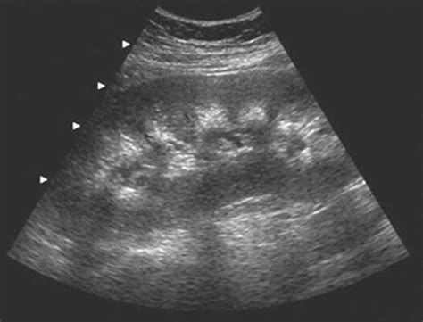 Nephrocalcinosis