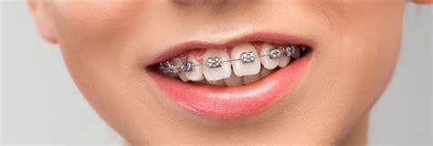 How Long Do You Have To Wear Braces To Fix An Overbite Elastics