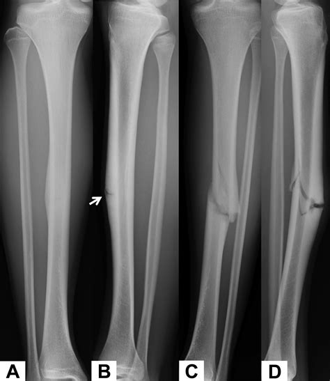 Recurrent Fracture After Anterior Tension Band Plating With Bilateral