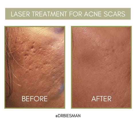 Acne Scarring Treatment Options Brian S Biesman Md
