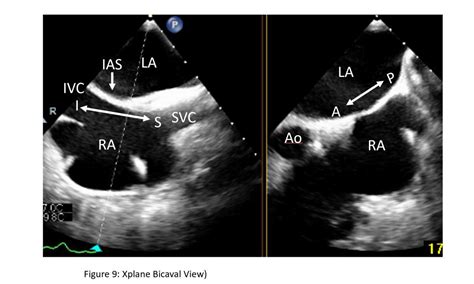 Catheter Based Mitral Intervention Imaging And Procedural Tee Ctsnet