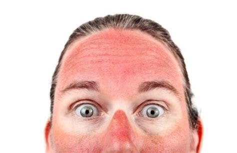 Sunburn Causes Prevention Short And Long Term Risks Skincarederm