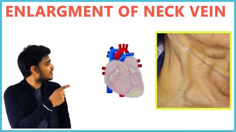 Jugular Venous Pressure Causes For Enlargement Of Neck Veins