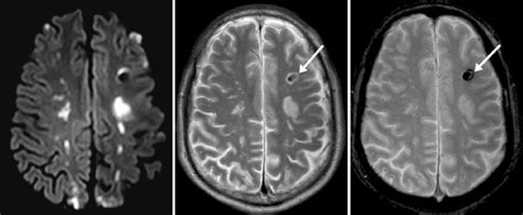 Hypereosinophilia With Multiple Thromboembolic Cerebral Infarcts And