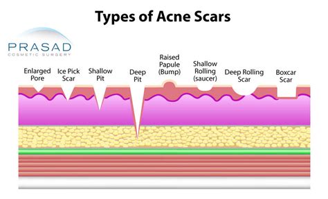 Rolling Acne Scar