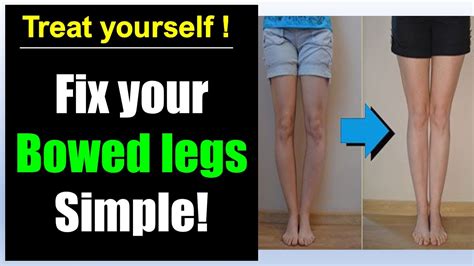 Bowed Legs Fix Simple Bowed Legs Exercise Correction Youtube