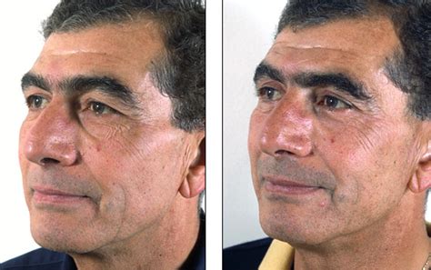 Dr Steven Denenbergs Facial Plastic Surgery Before And Afters Eyelid