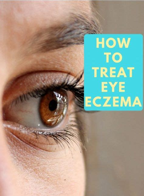 12 Best Eczema On Eyelids Images Eczema On Eyelids Eye Eczema Dry