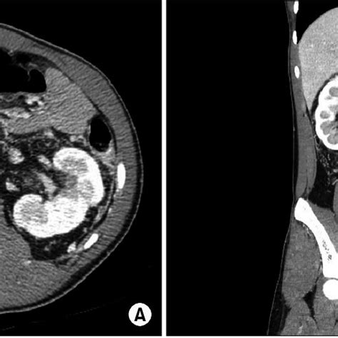 Contrast Abdomen And Pelvic Ct Scan A Transverse Ct Section Showed