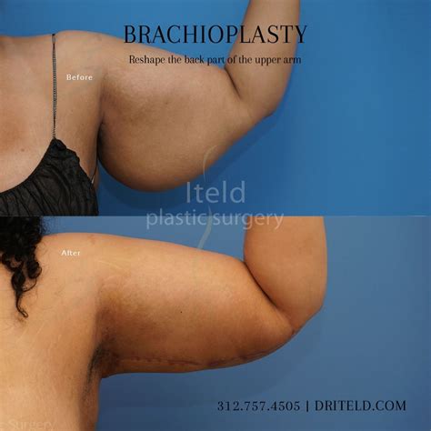 This Female Patient Had Excess Skin And Fat In Her Upper Arms Dr