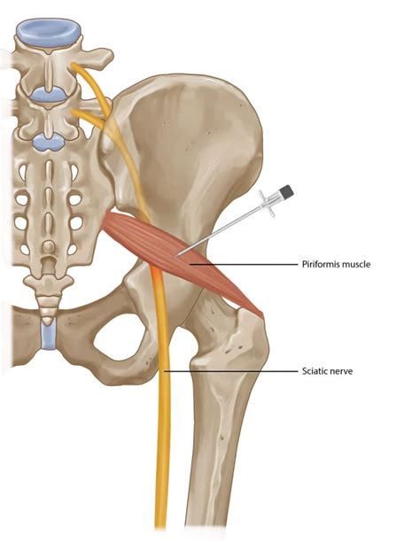 Piriformis Syndrome Treatment In Fairfax Va Sapna Spine And Pain