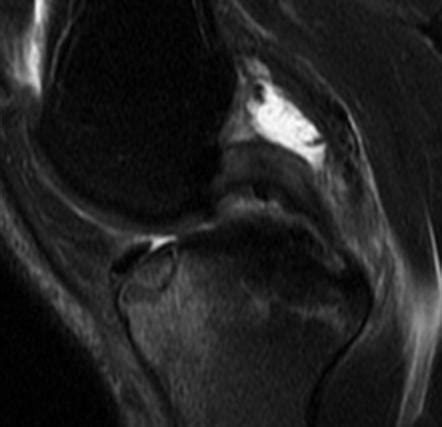 Hyperextension Injury Of The Knee Radiology Case Radiopaedia Org