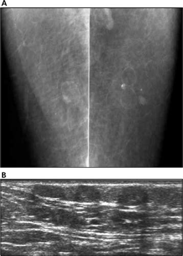 Spectrum Of Sonographic Findings In Superficial Breast Masses Kim
