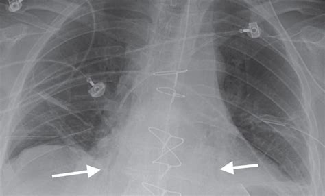 Atelectasis Radiology Key