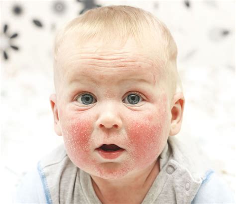 What Does Eczema Look Like On Babies What Does