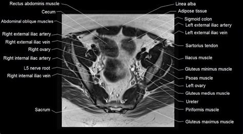 Mri Female Pelvis Anatomy Axial Image 11 Pelvis Anatomy Rectus